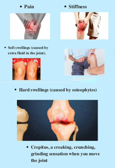 Symptoms of Knee Replacement
