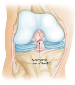 ACL Surgery in Jaipur