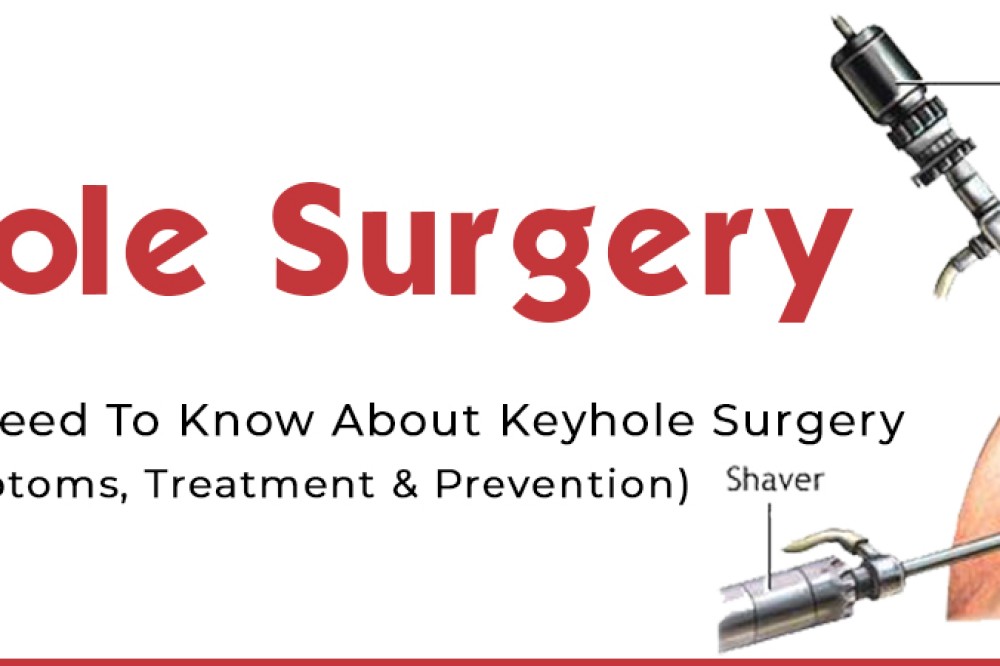 Keyhole Surgery : The key to treat sports injuries