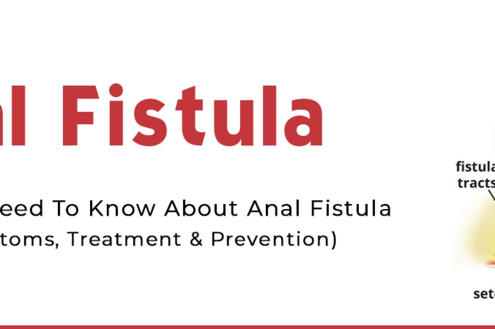 Anal Fistula : Know Its Causes, Symptoms, Treatment And Prevention
